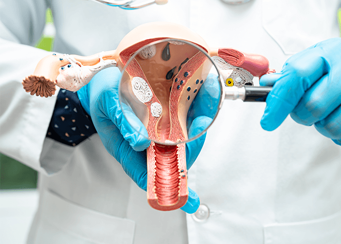 Intramural Fibroids