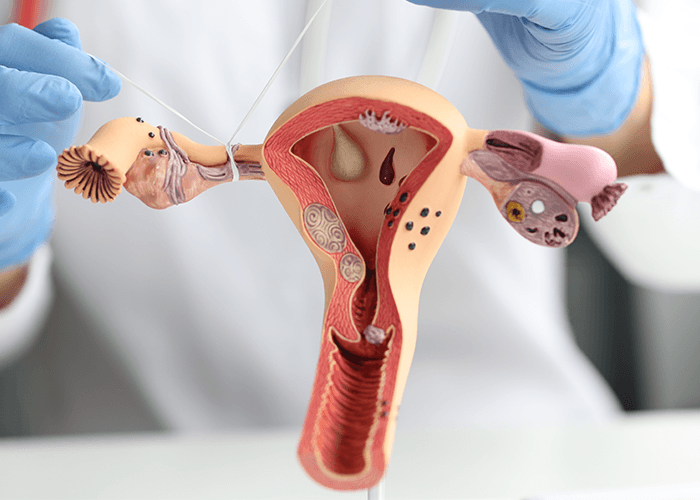 Intramural Fibroids