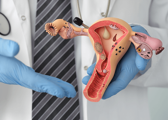 Submucosal Fibroids